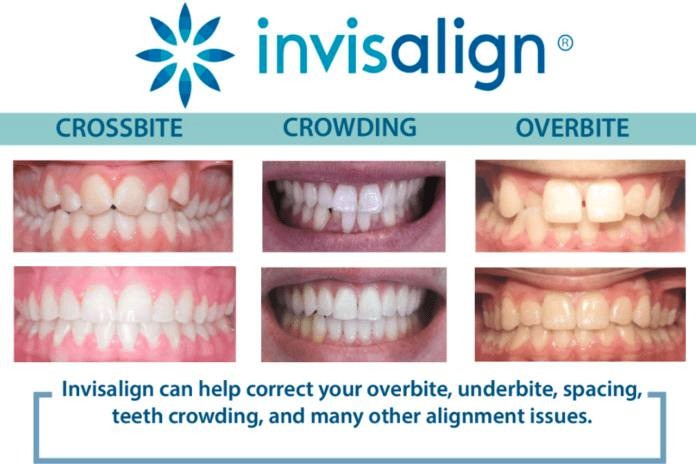 Invisalign